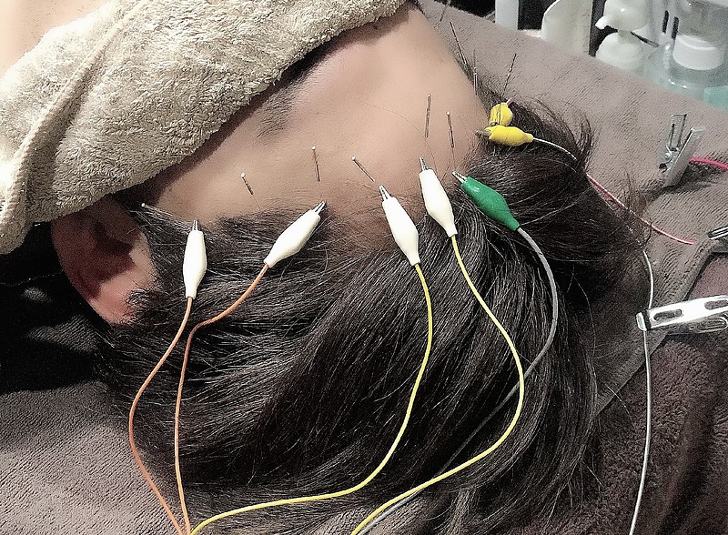 前の生え際に鍼周