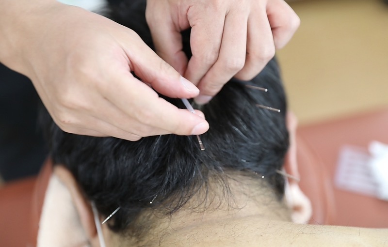 頭皮鍼後頭部 頭皮鍼後頭部