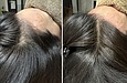 なぜ私は育毛鍼専門に力を入れているのか