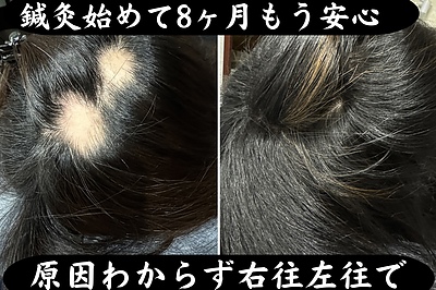 育毛鍼入門コース