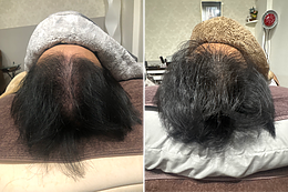 育毛鍼に興味はある。でも、自分にできるのかな？