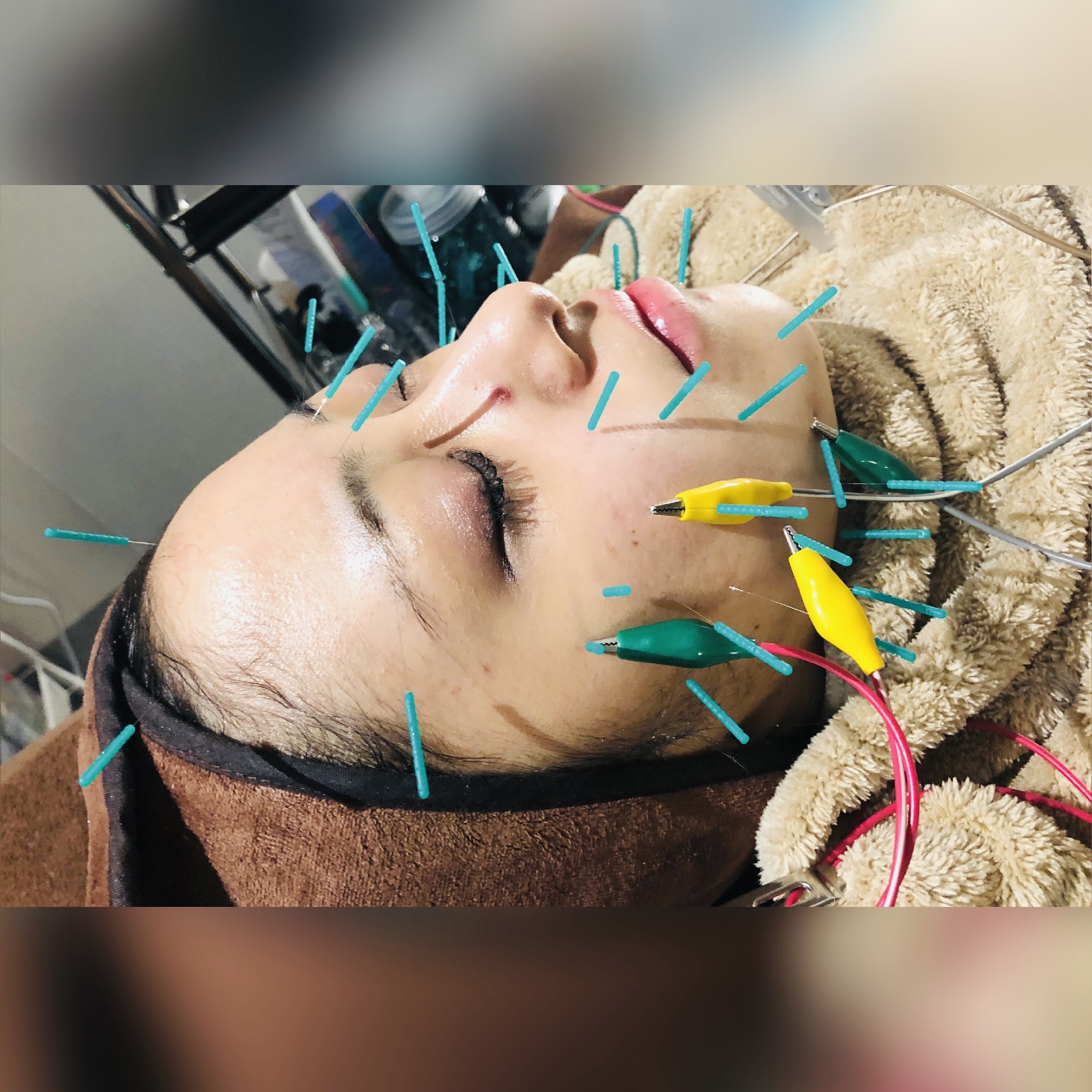 パルス美容鍼施術