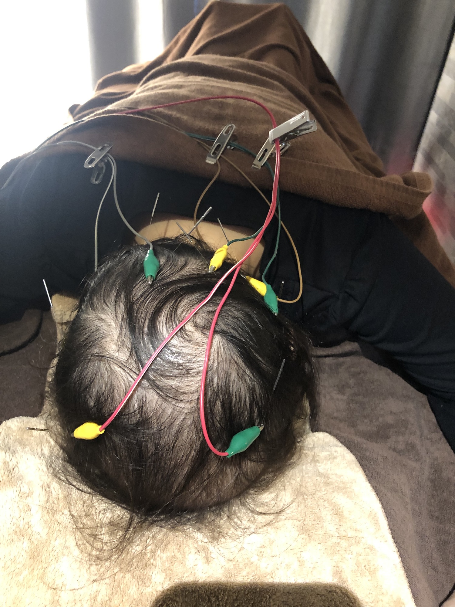 うつむき育毛鍼施術中女性