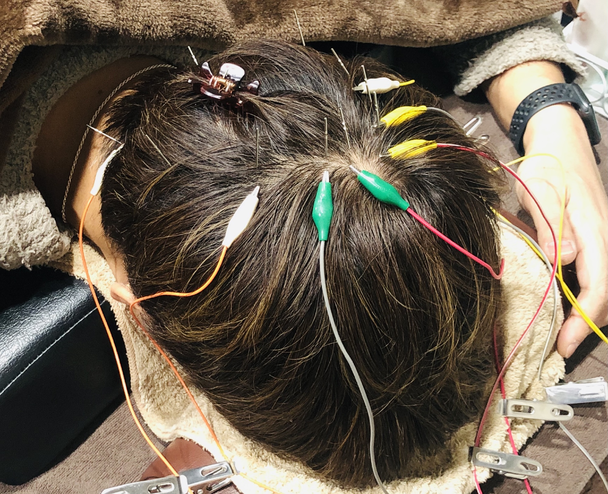 うつむき育毛鍼施術男性