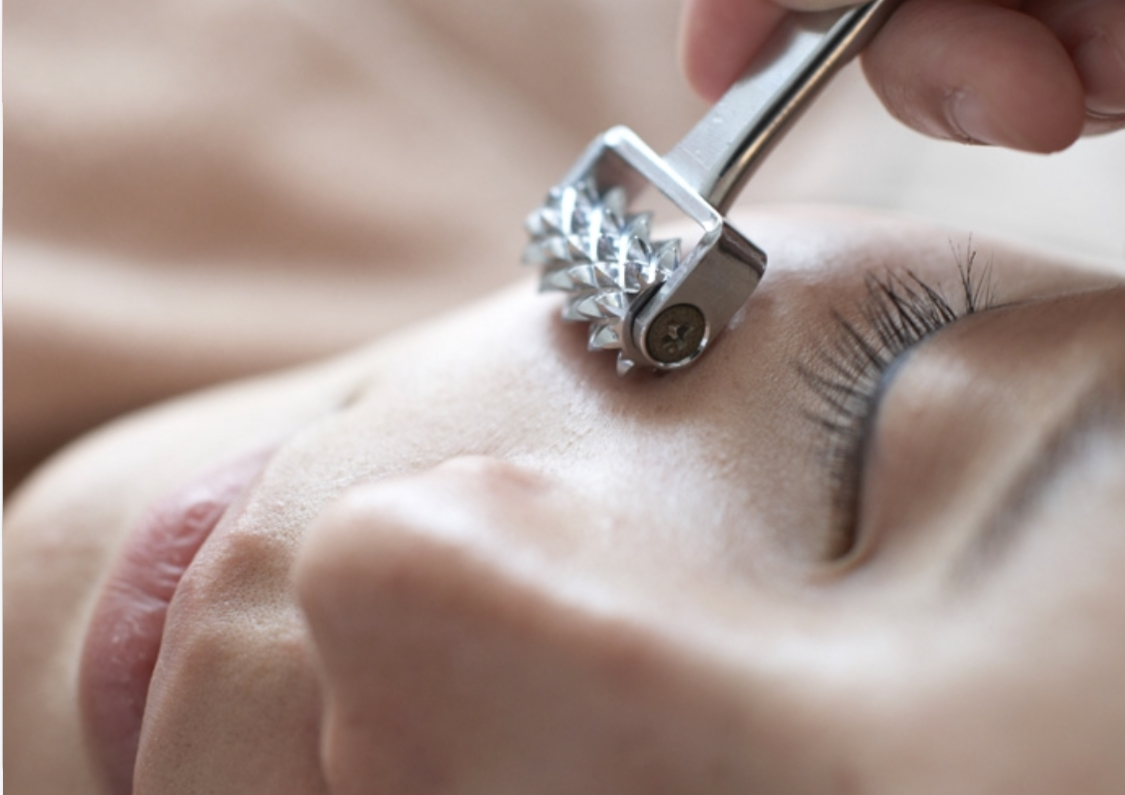 美顔コース鍼ローラー施術