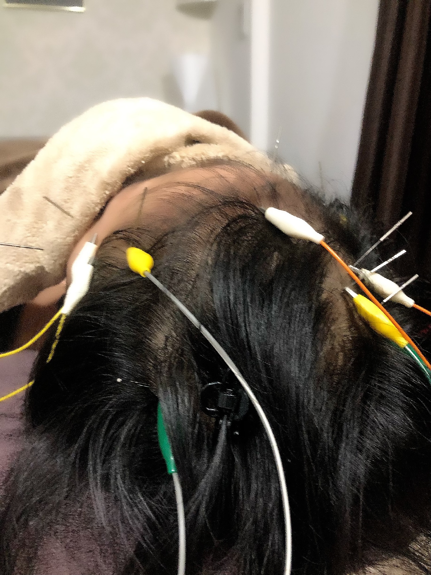 仰向き育毛鍼施術