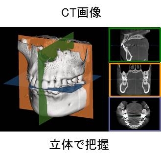 CT画像