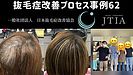 愛媛県西条市で抜毛症の改善は可能です。およそ12年間のお悩みから解放事例