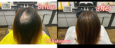 抜毛症をエクステ増毛で一時的にカバー