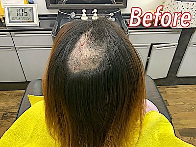 抜毛症を増毛エクステで一時的にカバー
