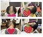 「もう止まらないと思っていた」30年続いた抜毛症との向き合い方