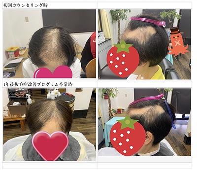「もう止まらないと思っていた」30年続いた抜毛症との向き合い方