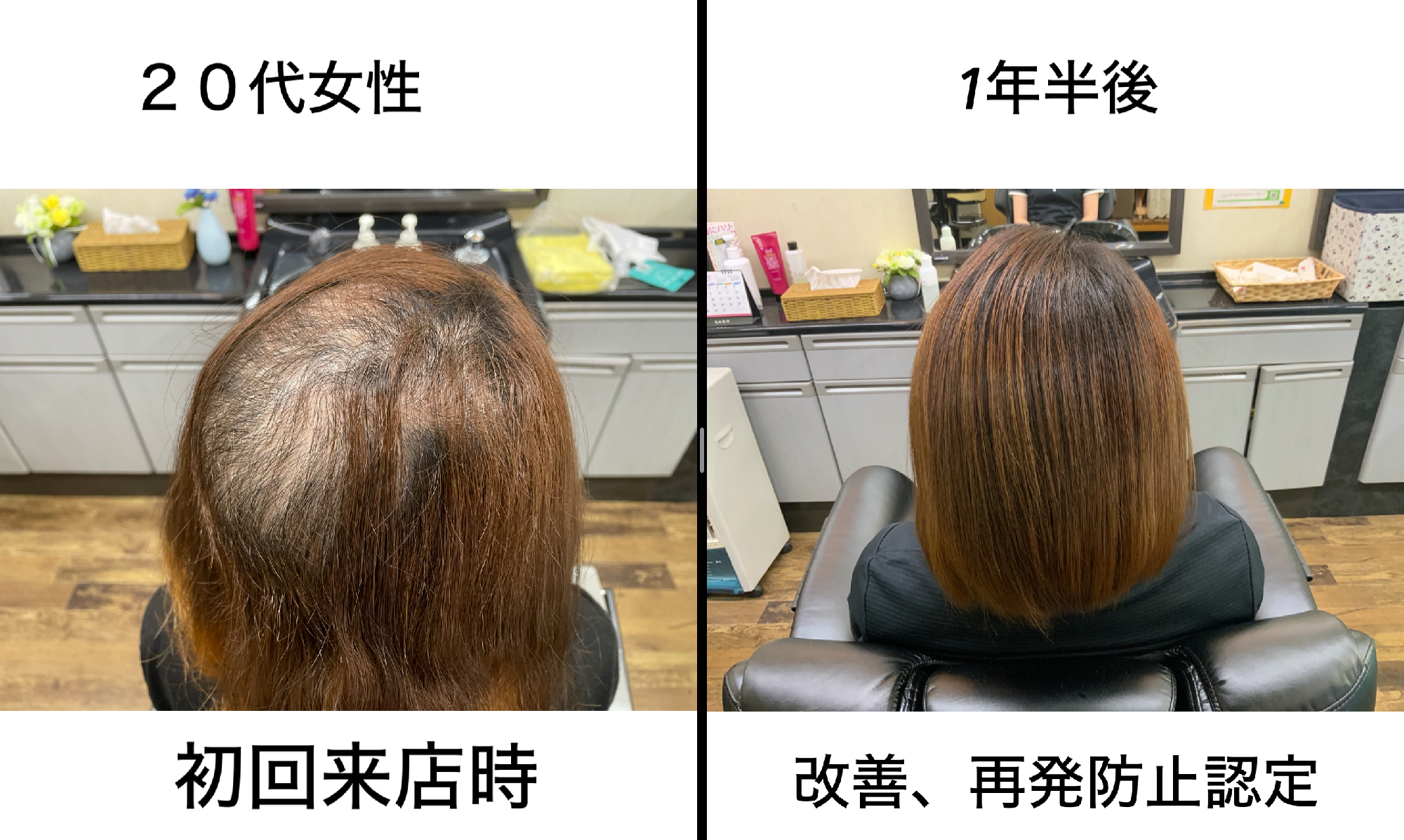 20代女性10年以上悩まされた抜毛症から解放