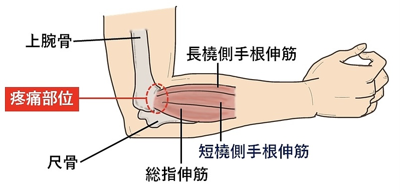 テニス肘2