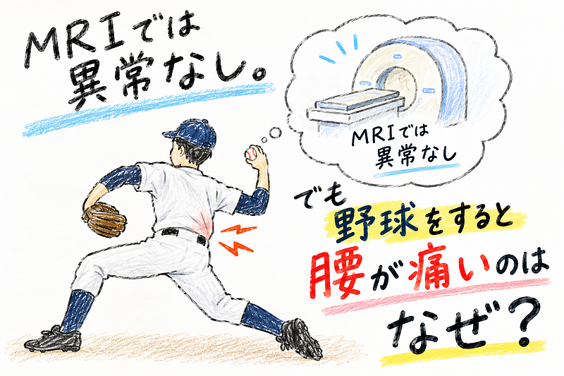 MRIでは異常なし。でも野球をすると腰が痛いのはなぜ? MRIでは異常なし。でも野球をすると腰が痛いのはなぜ?