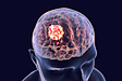 脳腫瘍の症状─徐々に頭痛や吐き気、身体のしびれや麻痺が強くなるなど