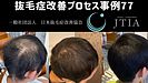 ★抜毛症改善プロセス事例77：15歳男性：ニット帽でいつも抜毛部を隠していたがどんどん面積が大きくなっていった