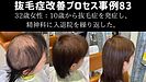 ★抜毛症改善プロセス事例83：32歳女性：10歳から抜毛症を発症し、精神科に入退院を繰り返した。