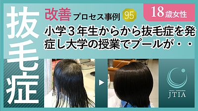 ★抜毛症改善事例：18歳女性：小学3年生からから抜毛症を発症し大学の授業でプールがあるかもしれないので・・