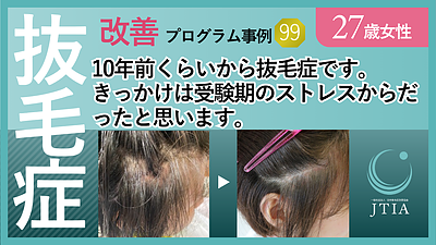 ★抜毛症改善プロセス事例99：27歳女性：きっかけは受験期のストレス。