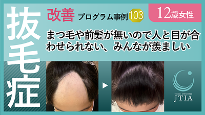 ★抜毛症改善プロセス事例103：12歳女性：まつ毛や前髪が無いので人と目が合わせられない、みんなが羨ましい