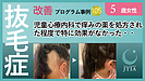 ★抜毛症改善事例105:5歳女性:児童心療内科で痒みの薬を処方された程度で特に効果がなかった・・
