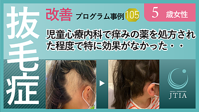 ★抜毛症改善事例105：5歳女性：児童心療内科で痒みの薬を処方された程度で特に効果がなかった・・