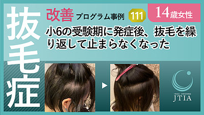 ★抜毛症改善事例111：16歳女性：小6の受験期に発症。少し治まったり、激しくなったりを繰り返し・・・