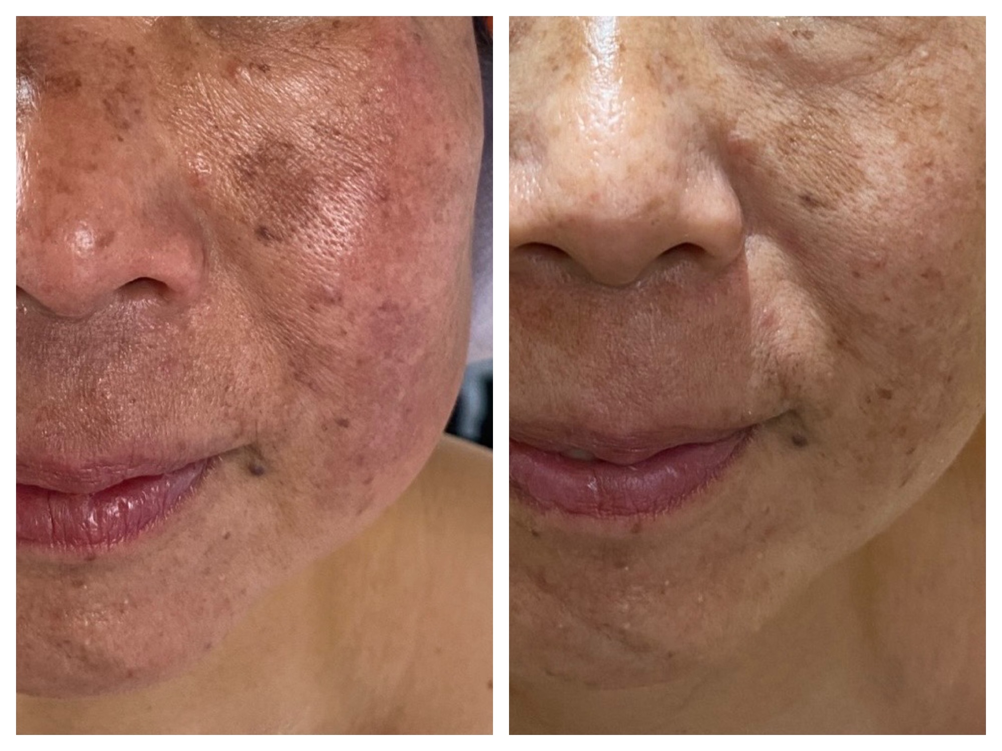 50代スキンケアでの変化。