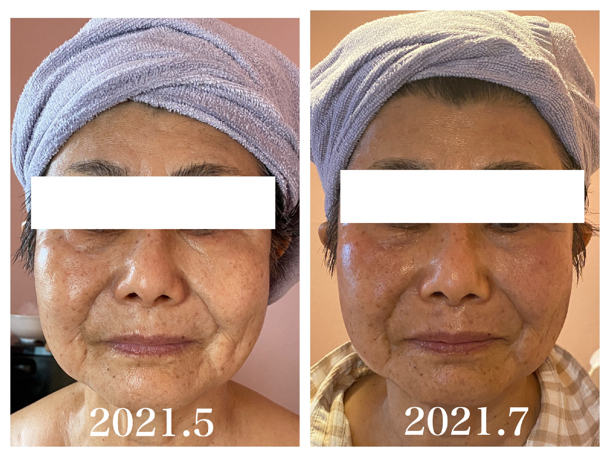 80代スキンケアでの変化。