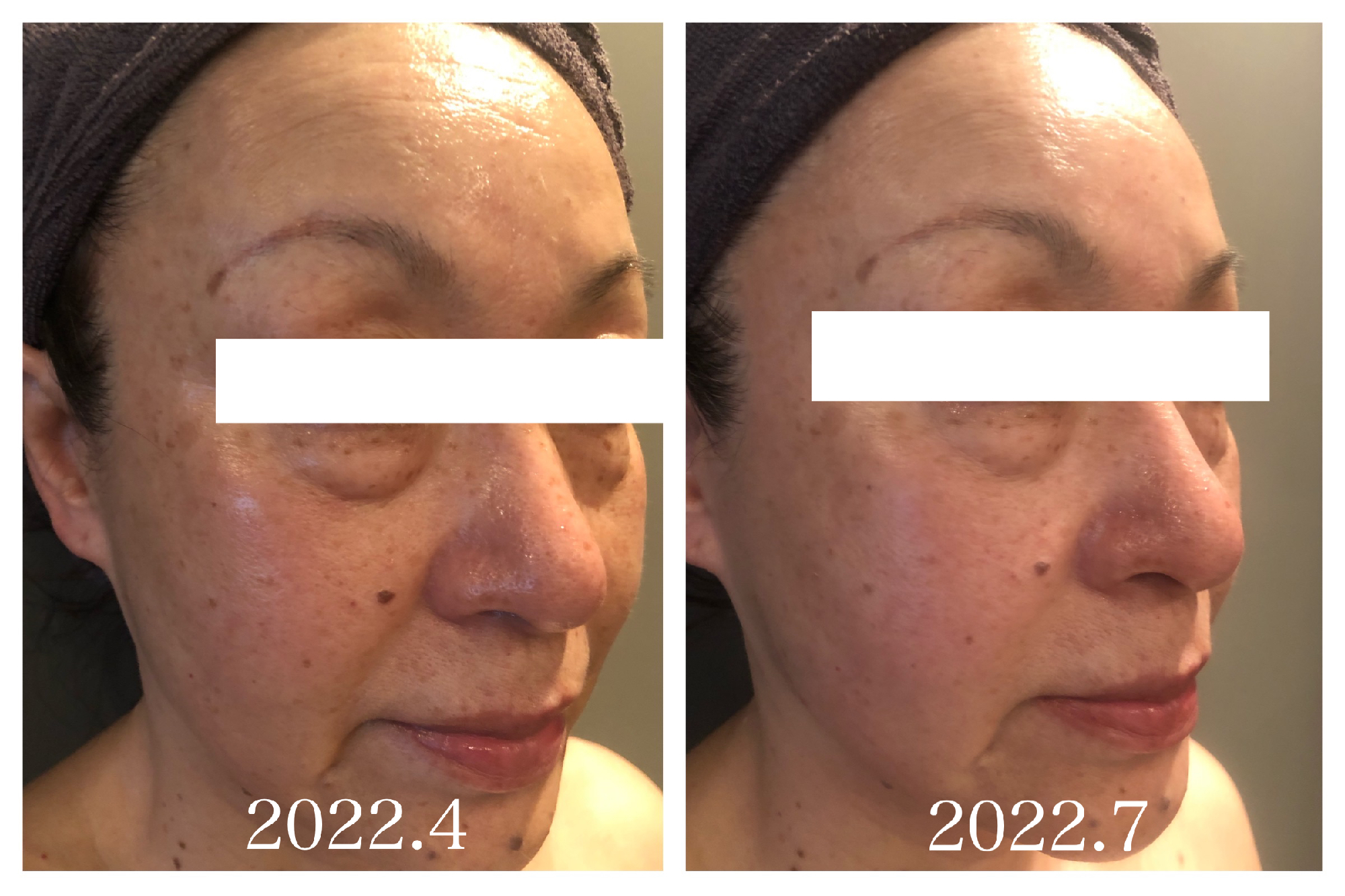 60代スキンケアでの変化。目の下、ほうれい線