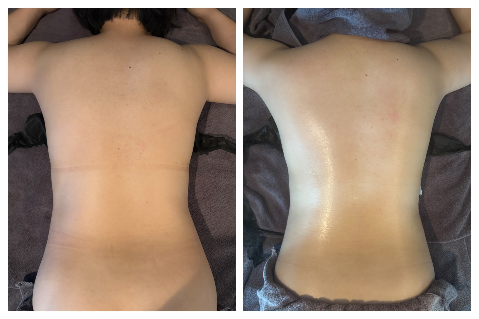 30代痩身施術前後。