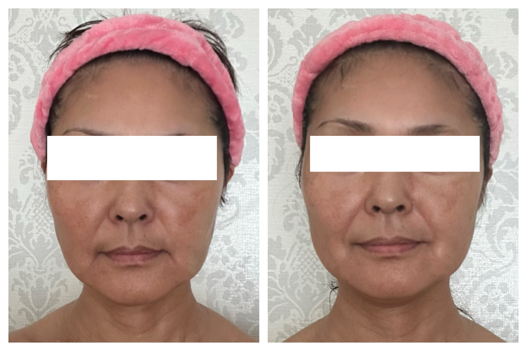 50代スキンケアでの変化。頬の大きなシミが薄く