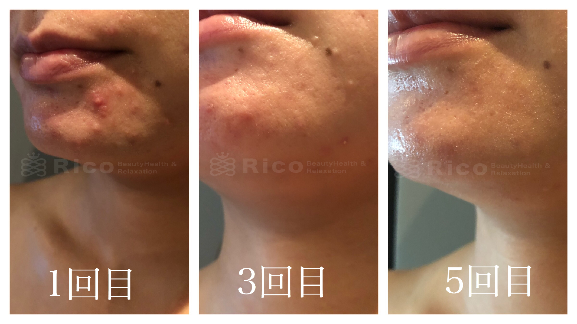 フェイシャル施術5回の変化。大人のニキビケア