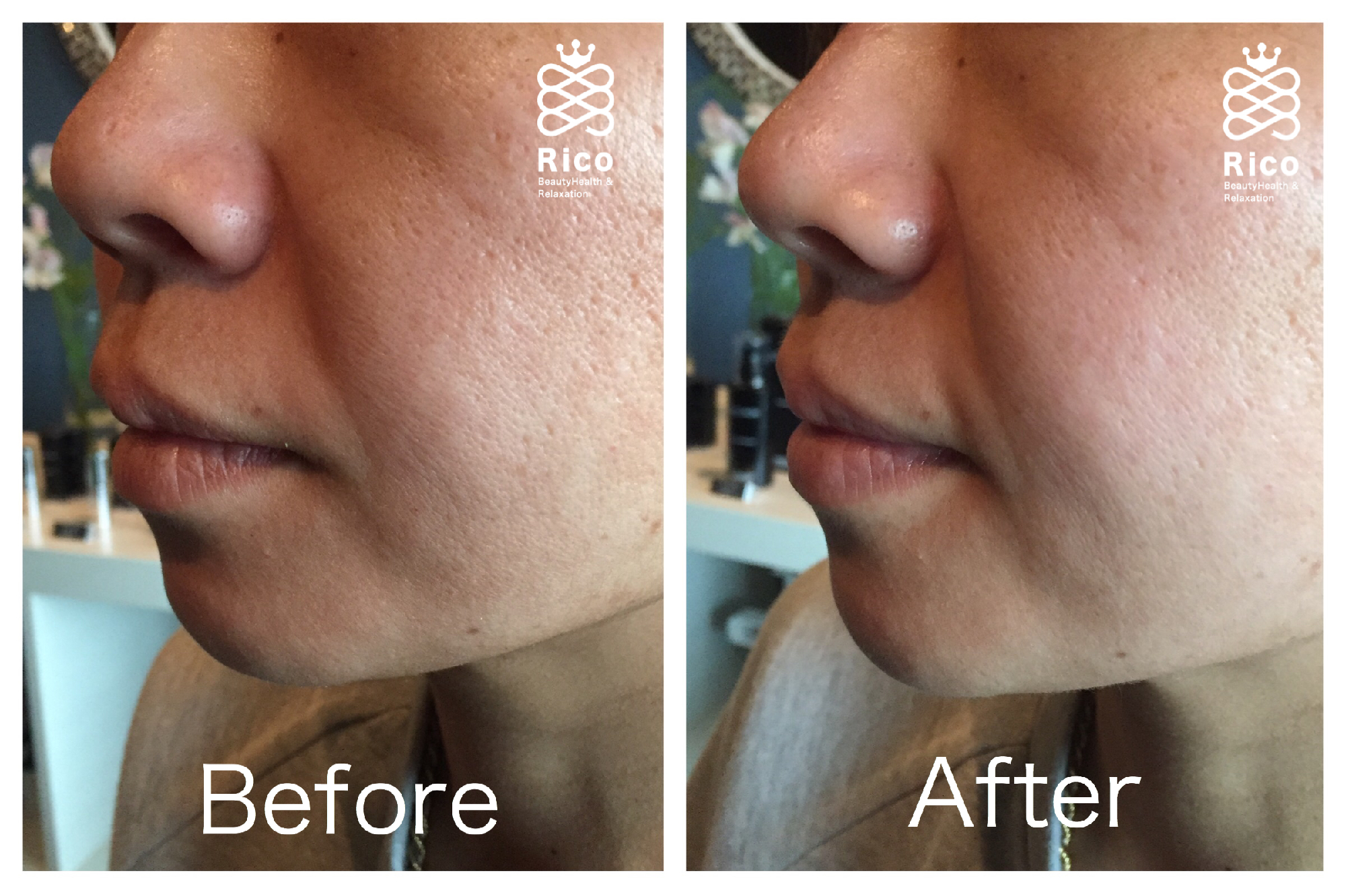 フェイシャル施術前後。頬の毛穴が目立たなくなりま