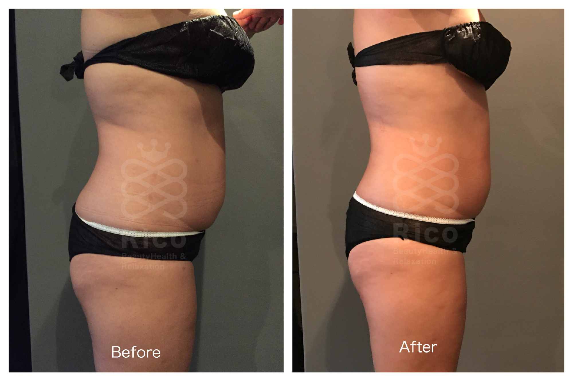 40代痩身施術での変化。