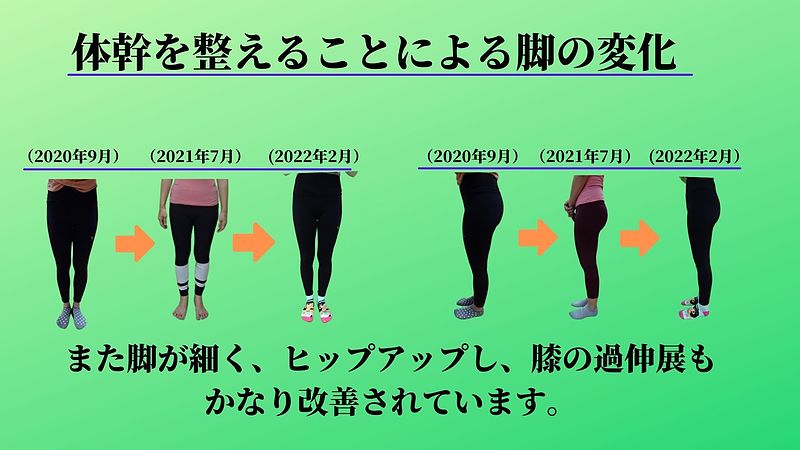 また脚が細くヒップアップ、膝の過伸展も改善