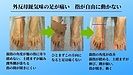 外反母趾気味の足の痛み、動きにくい指の改善