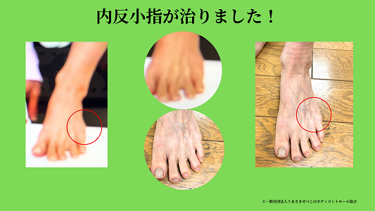 内反小指治りました! 内反小指治りました!