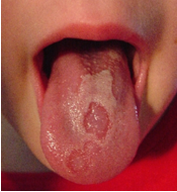 舌炎、地図状舌