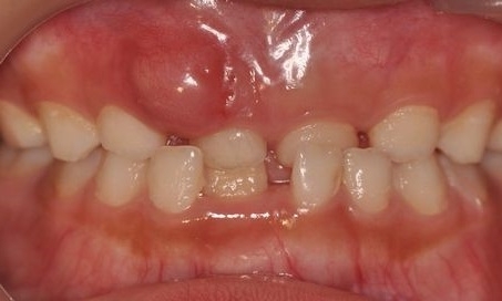 歯肉 歯ぐき が腫れたらどうする 歯科医師が解説する自分でできる応急処置とは 歯科医 飯田裕 マイベストプロ茨城