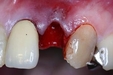 歯科医が応急処置を解説　顔面を強打で前歯が抜けてしまったら…歯の再植（歯の脱臼・口腔外科）