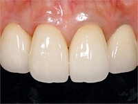 前歯のセラミック修復