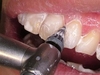 ＜歯科医が語る歯医者の裏側＞「なるべく歯を削らない」は当たり前ですよね？
