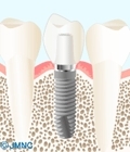 歯科用インプラント