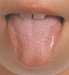 口内炎や舌の痛みを改善＝歯科で使う漢方薬とは？＜口腔外科・東洋医学（茨城/つくば・土浦）＞