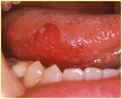 舌がん1