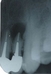 ＜歯科医が口腔外科疾患を解説＞歯の根の先にできる膿の袋＝歯根嚢胞ってなに？
