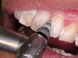 機械的歯面清掃（PMTC）