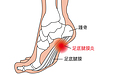 足裏の痛み（足底腱膜炎）は漢方薬と栄養療法で治りが早くなります！